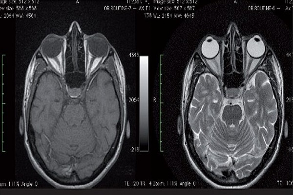 Chụp cộng hưởng từ (MRI) hốc mắt và thần kinh thị giác là gì